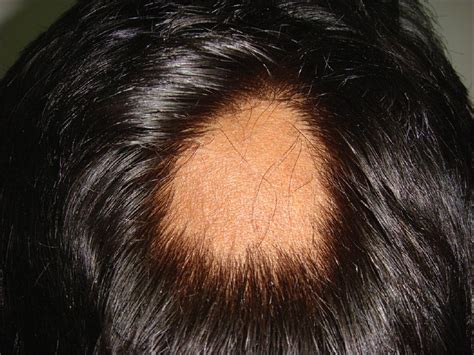 Topical photochemotherapy for alopecia areata. ALOPECIA AREATA - Injerto Capilar