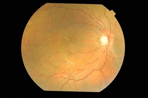 Branch Retinal Vein Occlusion With Macular Ischemia Retina Image Bank
