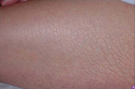 Asteatotic Dermatitis Eczema Craquelé Dermatology Advisor