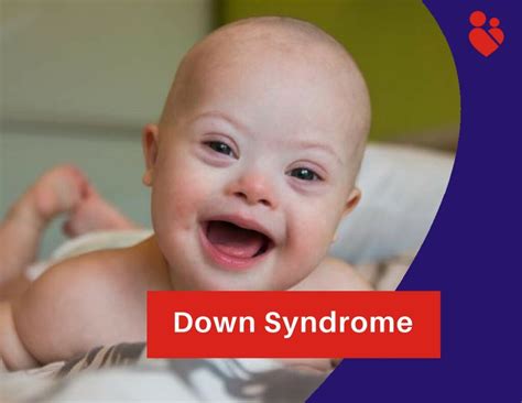 Down Syndrome Types Symptoms Causes And Treatment Santripty