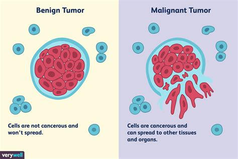 Benign Tumor Diagram