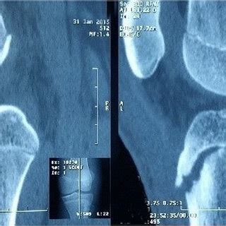 Fractures of the anterior tibial tubercle are infrequent lesions. knee X-rays showing a displaced avulsion fracture of the ...