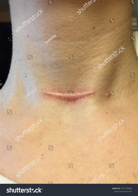 Closeup Red Raised Hypertrophic Keloid Scar Stock Photo 1751199698