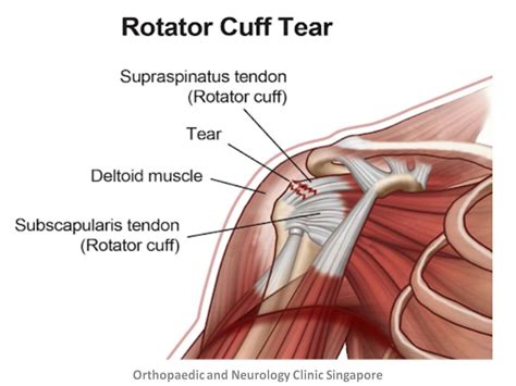 Rotator Cuff Injury Types