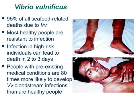 Vibrio Vulnificus