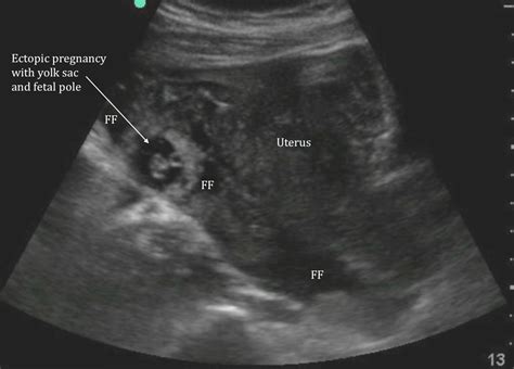 6 Weeks Ectopic Pregnancy Ultrasound