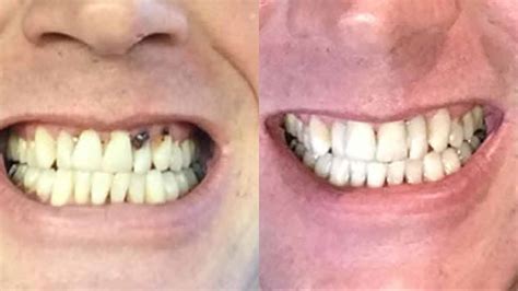 Chris Bonding White Filling Dental Implants Walton Dentistry