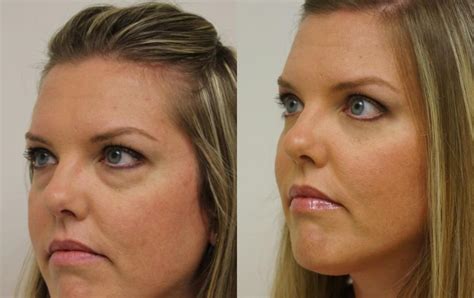 Great news!!!you're in the right place for eye lift tape. Eyelid Surgery Before & After Photos Patient 31 | Gilbert ...