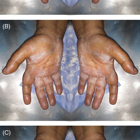 A 50 Years‐old Female With Hyperhidrosis Of Both Palms As Shown By The