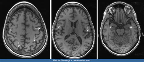 Dementia With Lewy Bodies Medlink Neurology