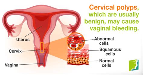 Vaginal Bleeding During Postmenopause