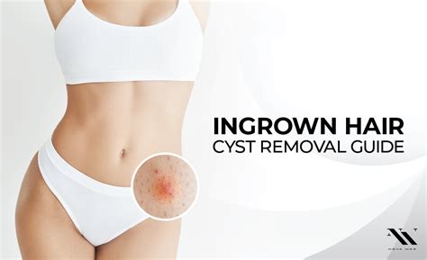 How To Treat And Remove Ingrown Hair Cysts 2023