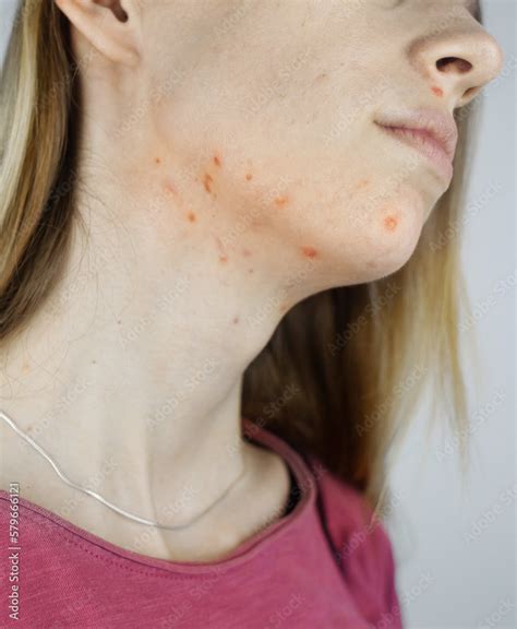 Foto De Girl Shows Acne On Her Face Acne On The Neck Demodicosis On