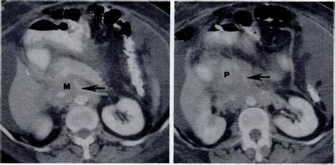 Ct Scans Of Patient With Lymphoma Show An Extensive Infiltrative