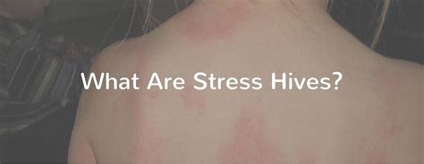 What Are Stress Hives What Is Stress Stress Hives