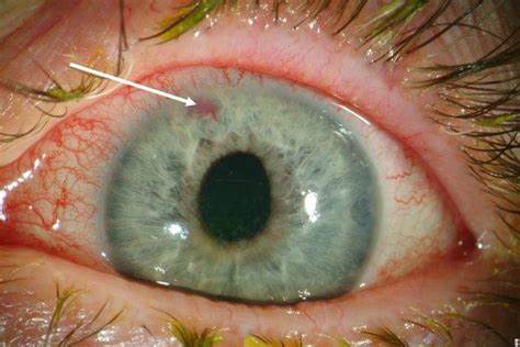 Жиросжигатели повышенное давление