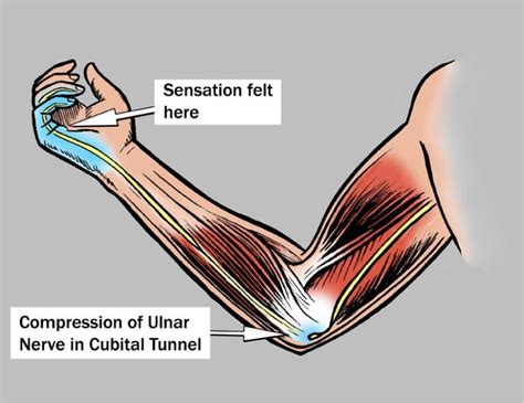 cubital tunnel syndrome causes symptoms diagnosis and treatment how to relief