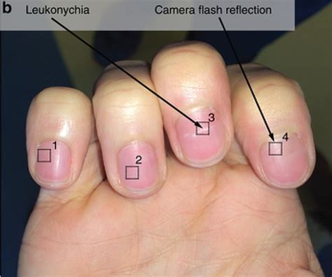 A New Cell Phone App Detects Anemia Through Photos Of Fingernails