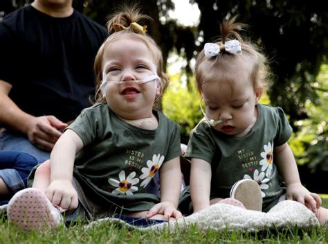 Rare Conjoined Twins Born Locked In Embrace Successfully Separated In