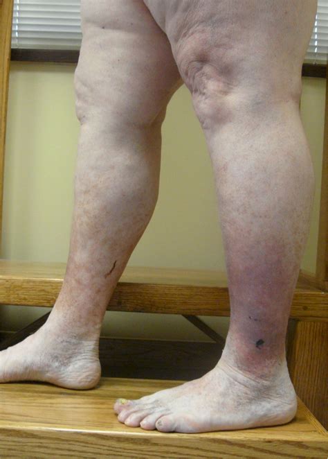 Eczema Legs