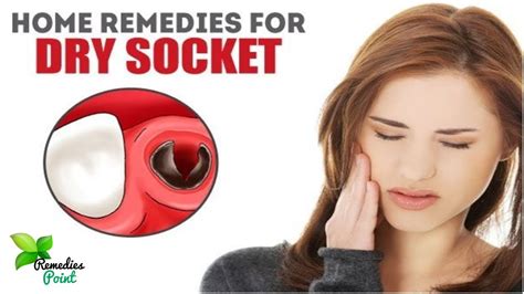 Home Remedies For Dry Socket Dry Socket Treatment Home Remedies To