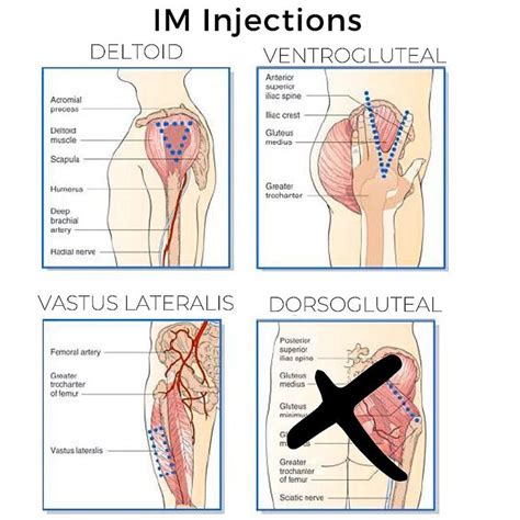Review Of Im Injections The Preferred Sites Are Deltoid Ventrogluteal And Vastus