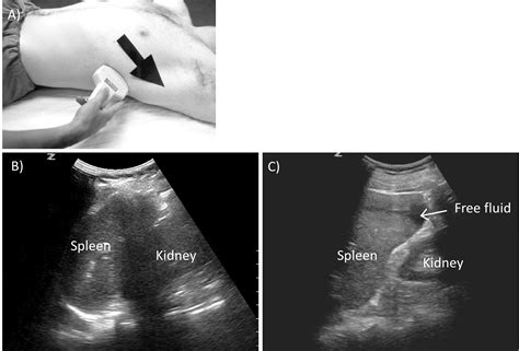 Ultrasound Focused Assessment With Sonography For Trauma Fast Exam