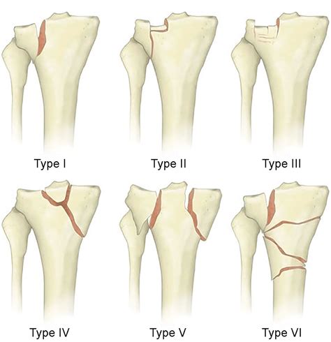 Cureus A Schatzker Type Iii Tibial Plateau Fracture In A Soccer Player A Case Report