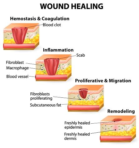 Know The 4 Stages Of Wound Healing Process New Health Advisor