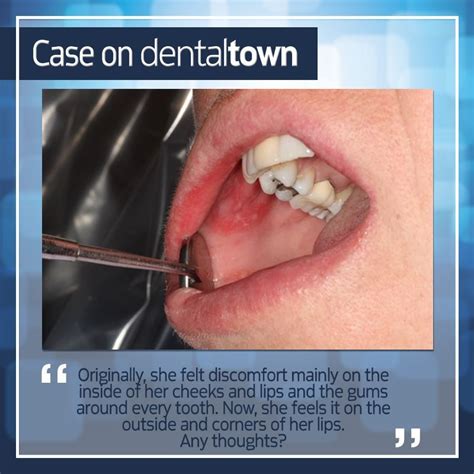 Dentaltown Case Need Help With This Oral Pathology Dentaltown Oral