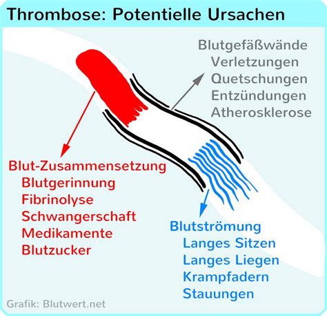 Da die symptome einer thrombose nicht eindeutig sind, müssen solche beschwerden schnell durch einen arzt abgeklärt werden, um komplikationen zu vermeiden. Thrombophlebitis - Ursachen und Symptome