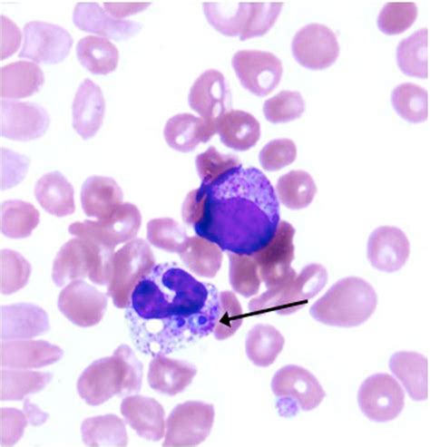 Blood Smear Stained With Wrights Stain Of A Patient With Disseminated