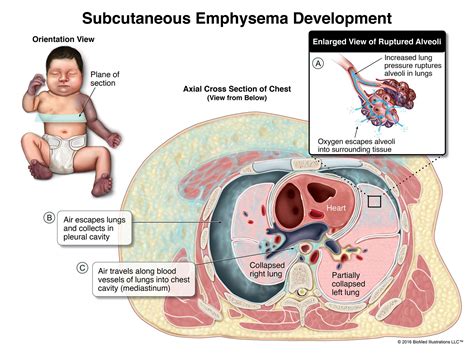 Subcutaneous Emphysema Development With Axial View Illustration By Biomed Illustrations Llc