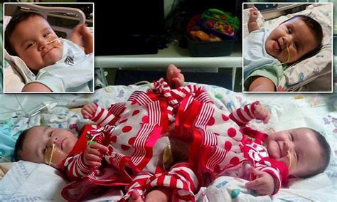 Rare Conjoined Twin Sisters Born In A Set Of Triplets Are Successfully