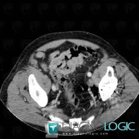 Colon cancer treatments can include surgery, radiofrequency ablation, cryosurgery, chemotherapy, radiation therapy, and targeted therapy. Cas radiologie : Cancer du sigmoïde (Scanner) - Diagnologic