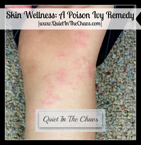 How To Get Rid Of A Poison Ivy Rash Overnight Artofit