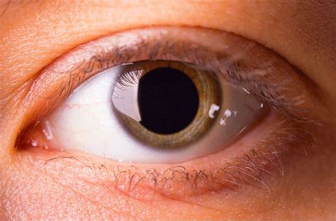 Mydriasis Dilated Pupils Causes And Treatment 42 Off