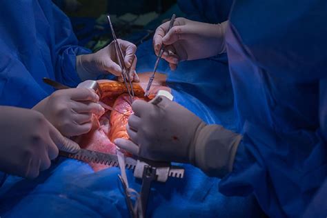learn about heart transplant surgery in delhi consult dr sujay shad health nigeria