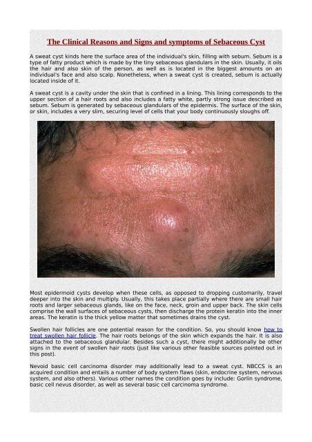 The Clinical Reasons And Signs And Symptoms Of Sebaceous Cyst