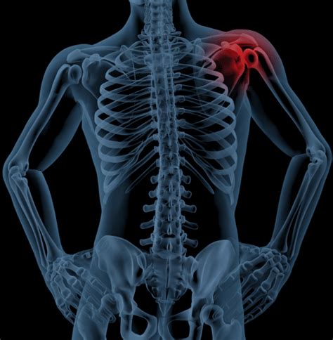 Shoulder Impingement Guide Resilience Orthopedics San Jose