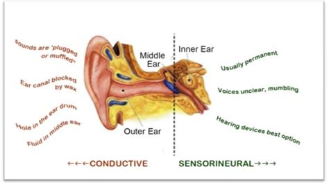 Different Types Of Hearing Loss Active Audiology