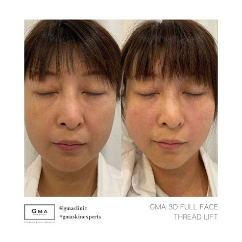 Pdo Thread Lift The Grand Medical Aesthetic Clinic