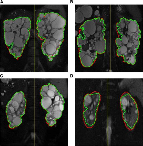 Automated Segmentation Of Kidneys From Mr Images In Patients With