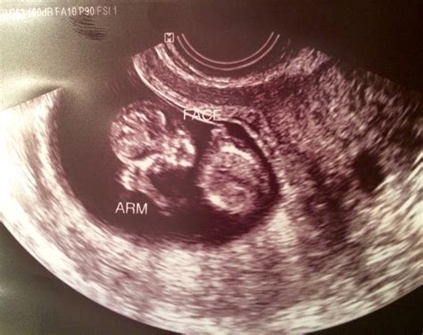 Second Trimester Ultrasounds Sharing Time — The Bump