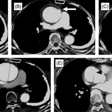 Serial Contrast Enhanced Computed Tomography Ct Images A At Onset
