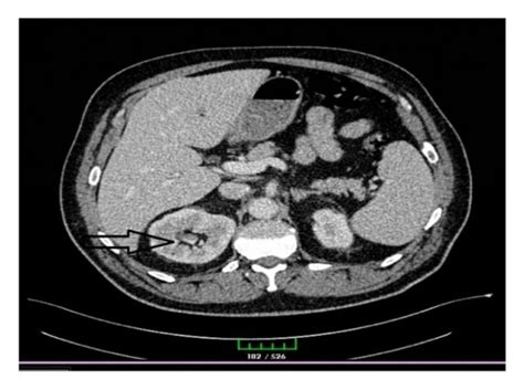 Ct Image Showing Hydronephrosis In The Right Kidney Download