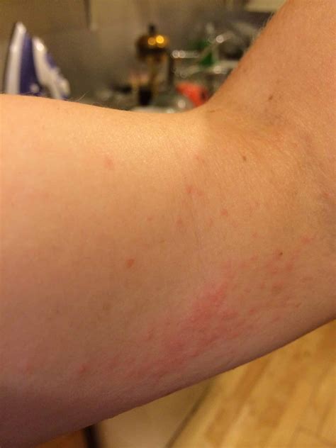 Bed Bug Rash The Essential Guide Includes Pictures And Signs