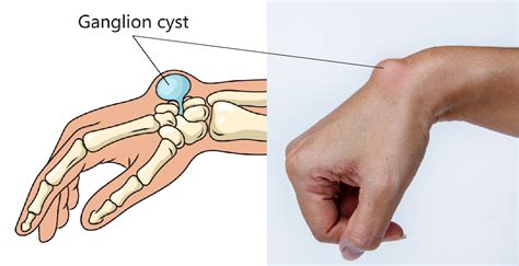 Ganglion And Mucous Cysts Golden State Orthopedics And Spine