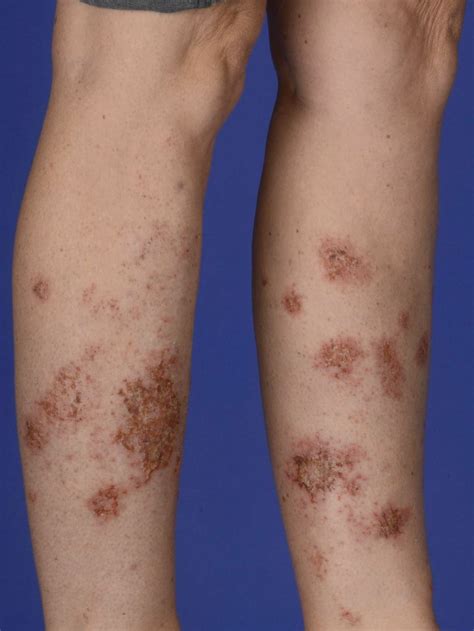 Nummular Dermatitis Article