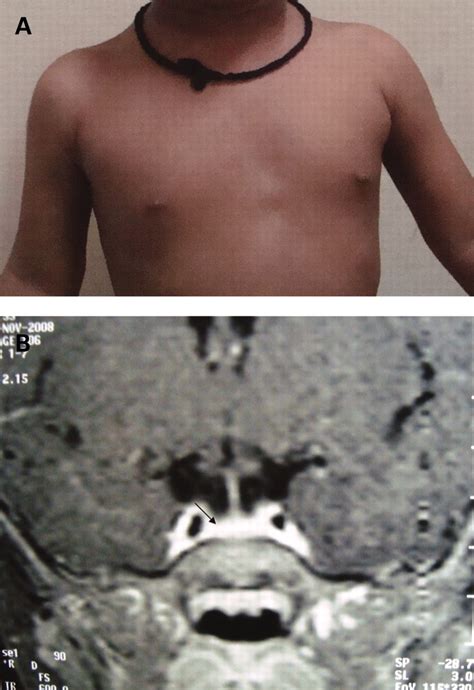 Precocious Puberty And A Sellar Mass Bmj Case Reports